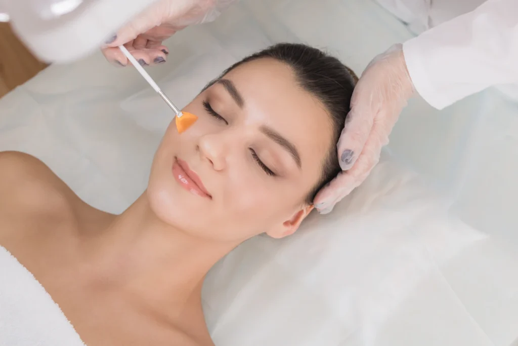 Chemical Peels