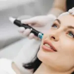 SkinPen Microneedling